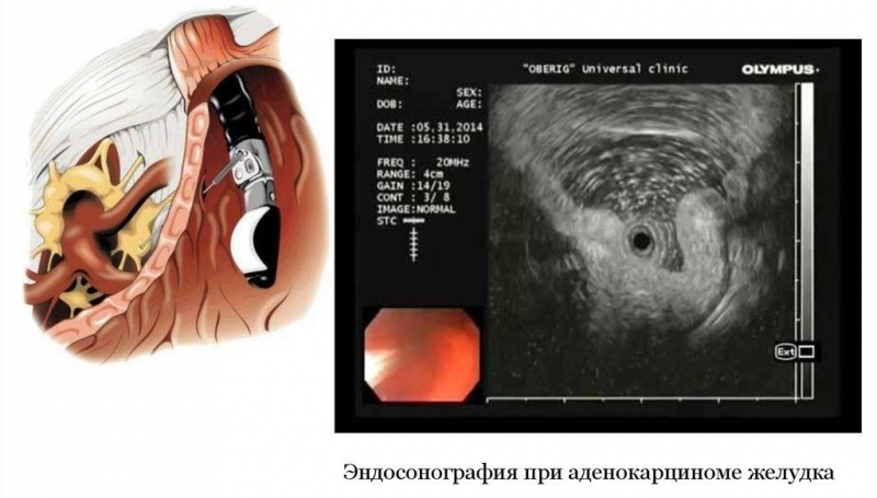 Эндоузи поджелудочной железы