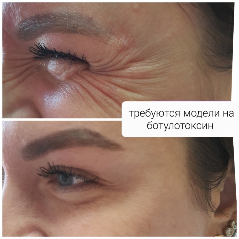 Ботулотоксин зона Королевский лифтинг Увеличение губ